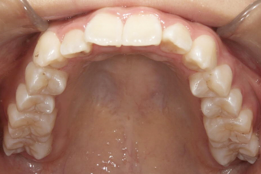 10代女性「前歯がでこぼこしている」重なり合った前歯と前に突き出した口元を、ワイヤー装置と歯並びを後ろに動かす「ヘッドギア」で整えた症例