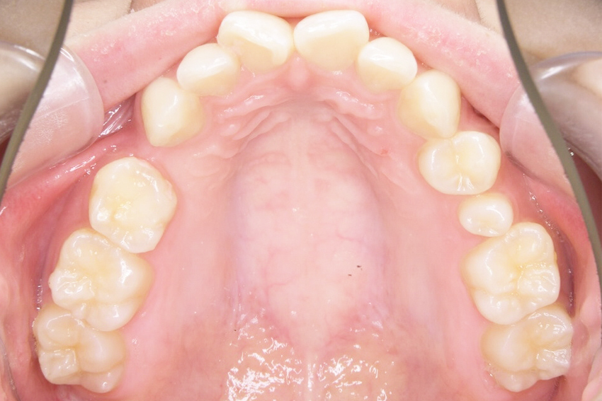 20代女性「前歯のデコボコが気になる」乳歯が残り、永久歯が足りないため、隙間に歯の移植を行って、「ワイヤー矯正」で歯並びを整えた症例