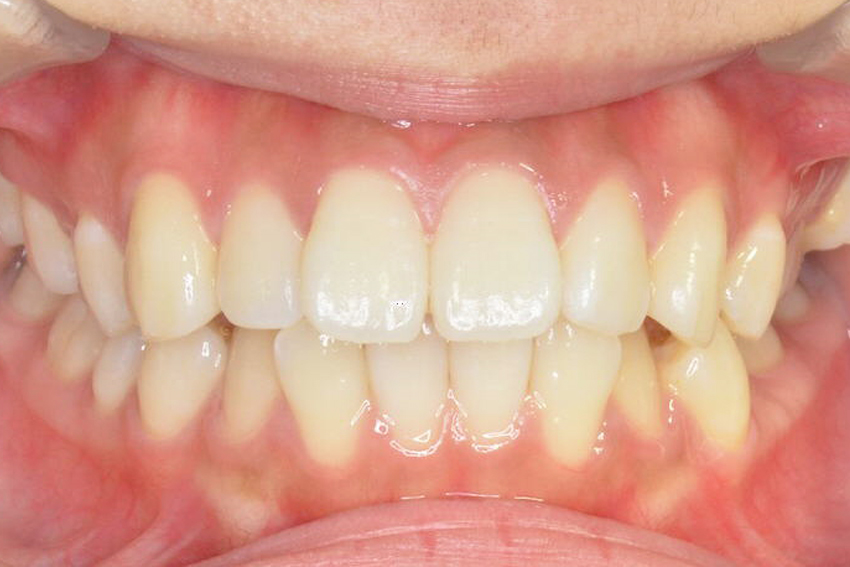10代女性「歯が上下でずれている」インプラントアンカーを使って矯正治療した症例