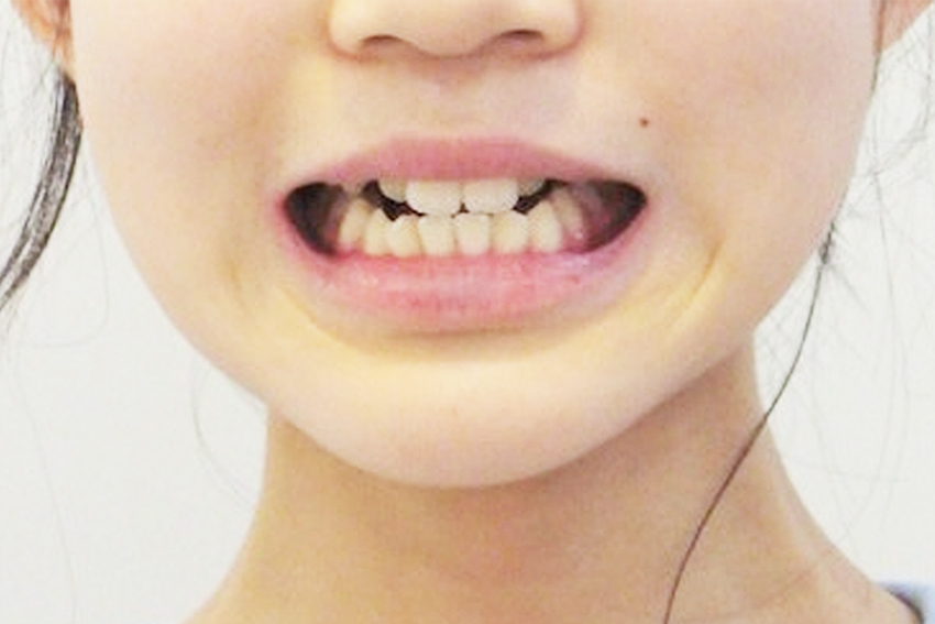 10代女性「歯が噛み合わないので治したい」前歯が噛み合わない「開咬」を、あごにネジを埋め込む「アンカースクリュー」とワイヤー矯正の併用、舌や口周りの筋肉を鍛える「口腔筋機能療法（MFT）」で治療した症例